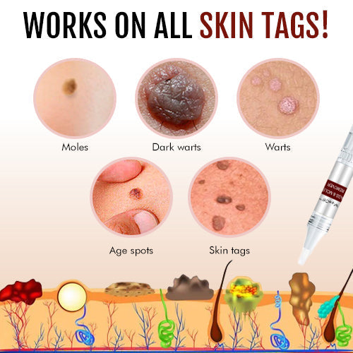 ššBUY 1 GET 1 FREEšLOVILDS⢠Tags & Moles Remover